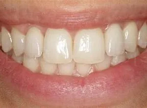 Harmonisations des Dents et des Gencives